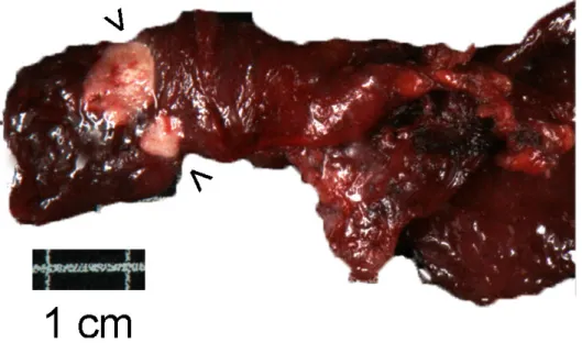 Figure 7 : Aspect macroscopique de carcinome papillaire de la thyroïde : présence de  deux nodules blanchâtres (flèches) sans capsule 