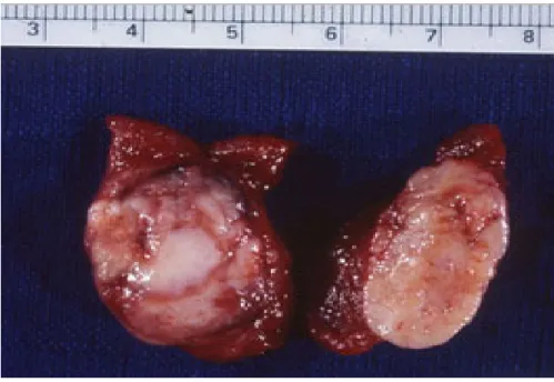 Figure 8 : Pièce de thyroïdectomie totale montrant un cancer médullaire de la thyroïde