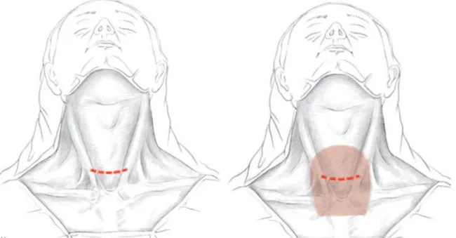 Figure 5 [7] : tracés de l'incision cervicale 
