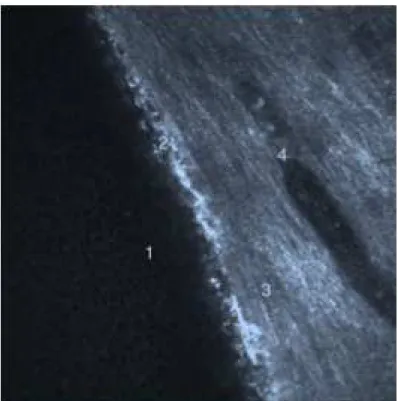 Figure 2 : Coupe transversale passant par le bord du même ptérygion au  niveau de son col 