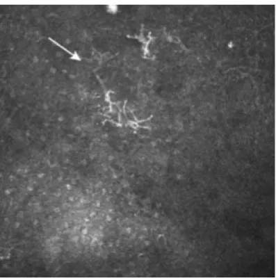 Figure 5 : Nombreuses cellules dendritiques (flèche) dans le stroma  cornéenen regard de la tête d’un ptérygion actif : 
