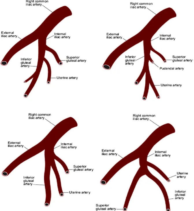 Figure 8. Figure illustrant les variations anatomiques les plus fréquentes dans  l’anatomie de l’artère iliaque interne avec une référence spécifique à l’origine des 