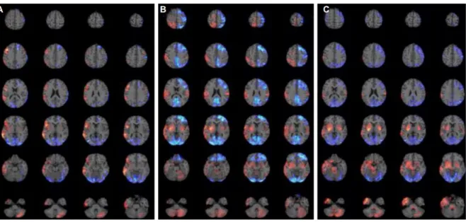 Figure 15 : Résultats de PET-scan de la phase aiguë chez trois patients atteints  d'encéphalite anti-NMDAR
