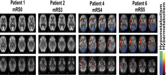 Figure 16: Des images représentatives de métabolisme anormal du glucose cérébral chez  des patients avec encéphalite à anticorps anti-récepteur N-méthyl-D-aspartate détectée 