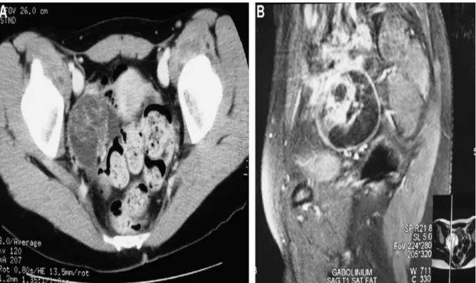 Figure 19: IRM. Tumeur annexielle droite abdominopelvienne hétérogène, kystique,  avec prise de contraste