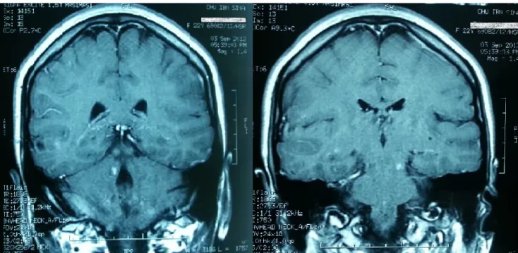 Figure 4 : IRM cérébrale T2 montre des plages lésionnelles intéressant la substance  blanche sous-corticale temporale gauche, le noyau lenticulaire, ainsi que le pédoncule 