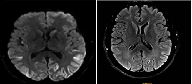 Figure 1: IRM cérébrale du patient en séquence diffusion et Flair 