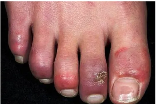 Figure 10 : Les engelures ulcérées des orteils 