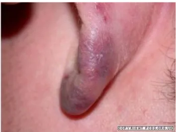 Figure 13 : Infiltrat violacé de l’oreille 