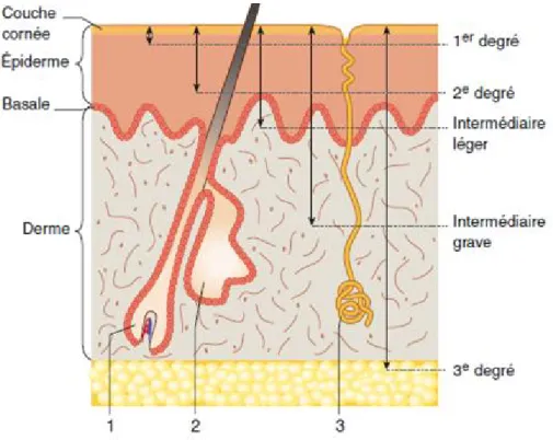 Figure  4 : Histologie  de  la  peau  et  de  la  profondeur  de  la brûlure. 1, Poil, 2, glande sébacée, 3, glande sudoripare [84].