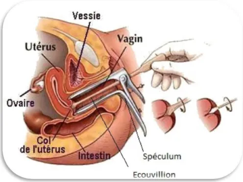 Figure 2 : Prélèvement endocervical et vaginal sous spéculum 