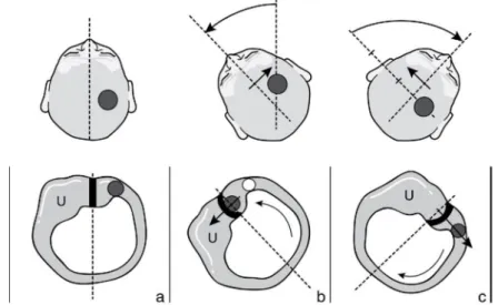 Figure 10 : Canalolithiase du canal horizontal droit se présentant avec un nystagmus  horizontal antigéotropique