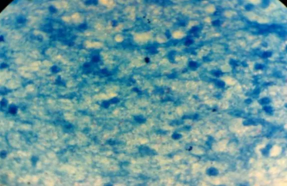Figure 10 : ZIEHL NEELSEN A PARTIR DU PUS D’UNE ULCERATION CUTANEE, service de  microbiologie, HMIMV RABAT 2010 