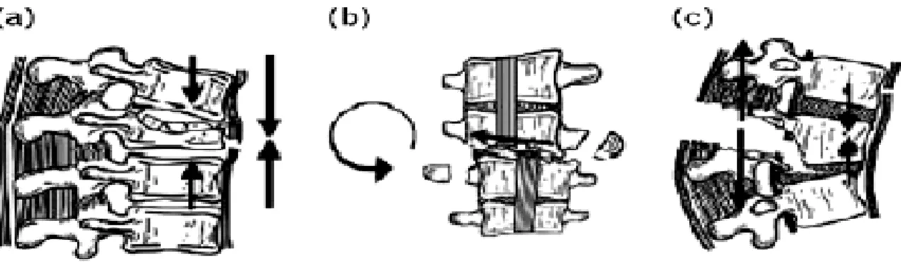 Figure 12  :   les  trois  types  du  mécanisme  lésionnel :  (a) :  en  compression,  (b)  en  rotation,  (c)  en  distraction [24,25]