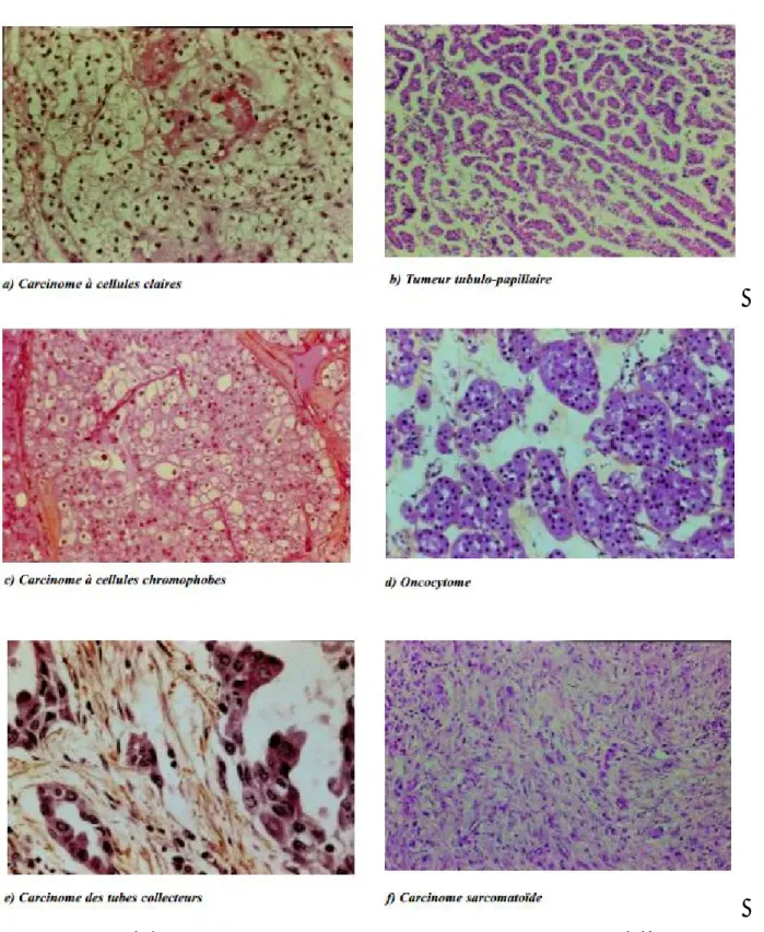 Figure 3 : Les aspects microscopiques des carcinomes à cellules rénales. [14] 