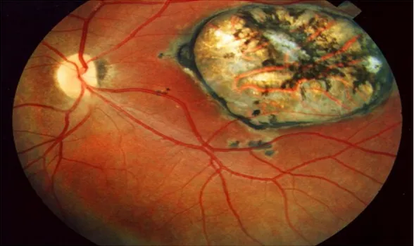 Fig  n°9 :  une  cicatrice  maculaire  secondaire  à  une  toxoplasmose  congénitale.  L’acuité  visuelle de ce patient est de 20/400