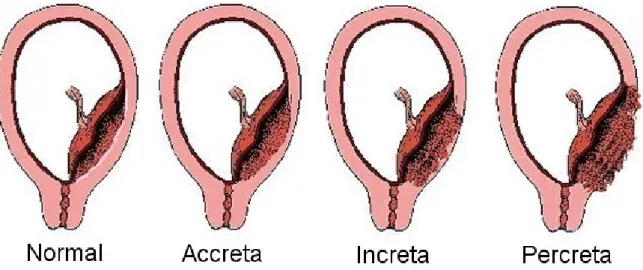 Figure 1 : Les différentes variétés anatomiques du placenta accreta. (5) 