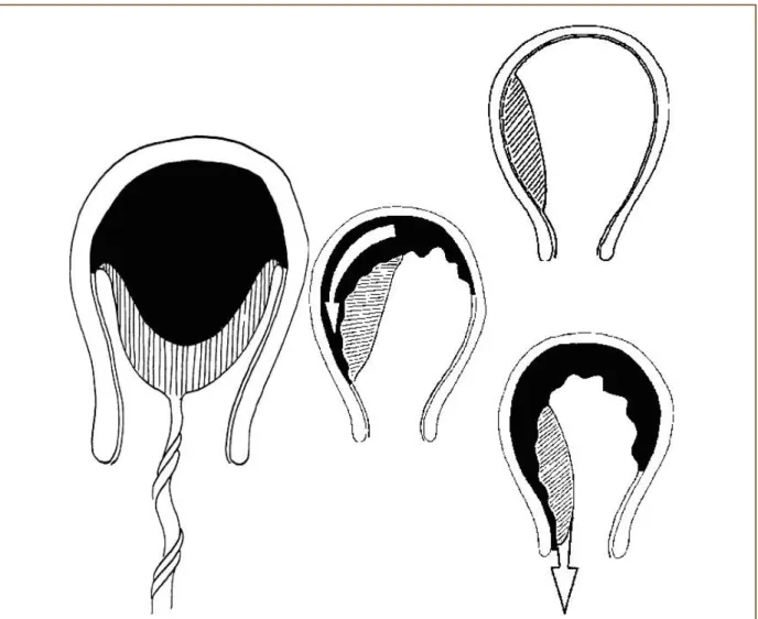 Figure 15: Schéma montrant le décollement placentaire. (21) 