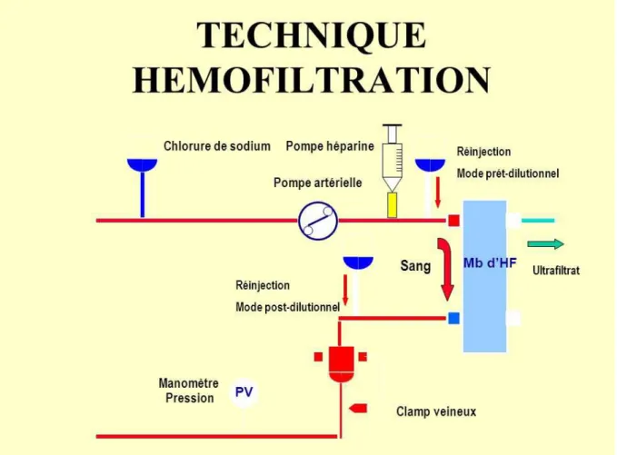 Figure 6 : Technique de l’hémofiltration 