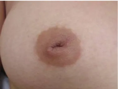 Figure 11: image de rétraction mamelonnaire lors d’un cancer du sein 