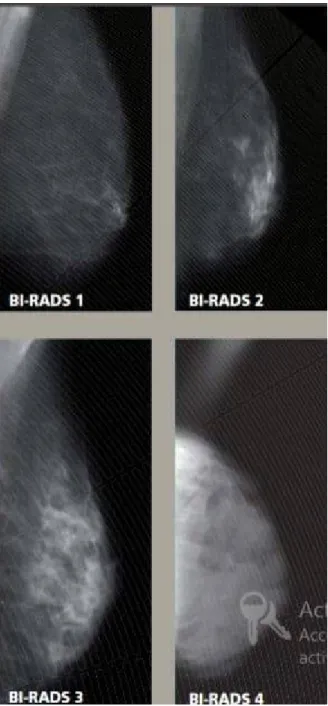 Figure 18: classification de BI-RADS selon la densité mammaire 
