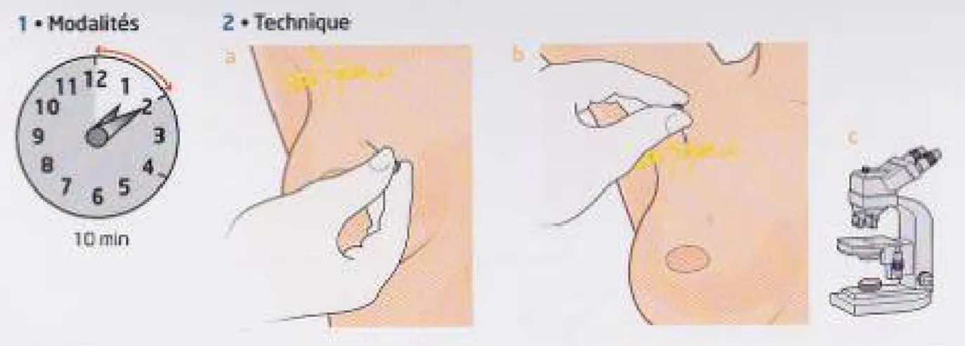 Figure 26: technique de cytoponction 