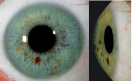 Figure 1 : La cornée normale est transparente et permet   d'avoir une vision claire des détails de l’iris [16]