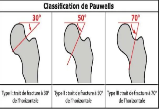 Figure 10 : classification de Pauwels [10]. 