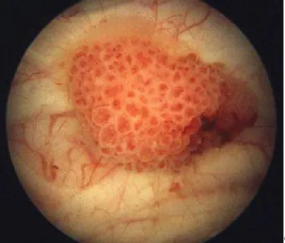 Figure 4: Aspect endoscopique d’une tumeur de vessie papillaire bourgeonnante à la  cystoscopie 