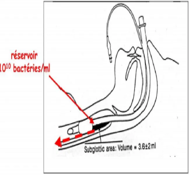 Figure 2 : Coupe sagittale montrant l’accumulation des sécrétions sous-glottiques (flèche  noire) provenant des différents réservoirs bactériens préalablement trans-colonisés 