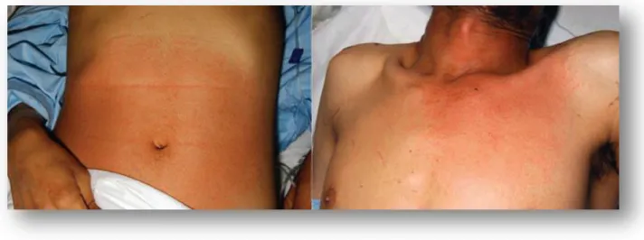 Figure 7 : Deux cas de cellulites (une au pelvis et l’autre au niveau de la nuque)   causée par l’acinetobacter baumannii chez un patient américain blessé dans la guerre d’Irak 