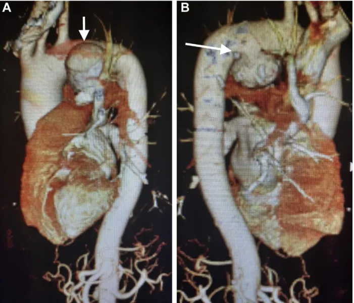 Figure 9 :  A/Angiographie tomodensitométrique tridimensionnelle montrant un  grand faux anévrisme (flèche) de l'aorte thoracique
