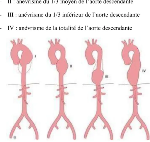 Figure 15 : Classification des anévrismes de l’aorte descendante. 