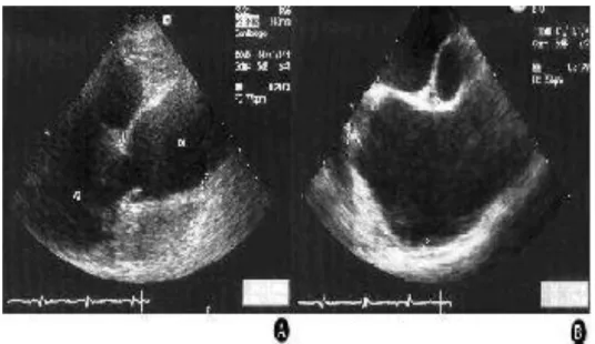 Figure 17 :  A. Échocardiographie trans-thoracique incidence para-sternale coupe  grand axe : anévrisme prédominant à la partie moyenne de l'aorte ascendante  mesuré à 59mm