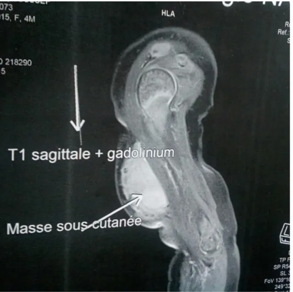 Figure 2 : IRM coupe sagittale en T1 du bras droit montrant un processus tumoral   de siège sous cutané sans calcification, ni composante graisseuse 