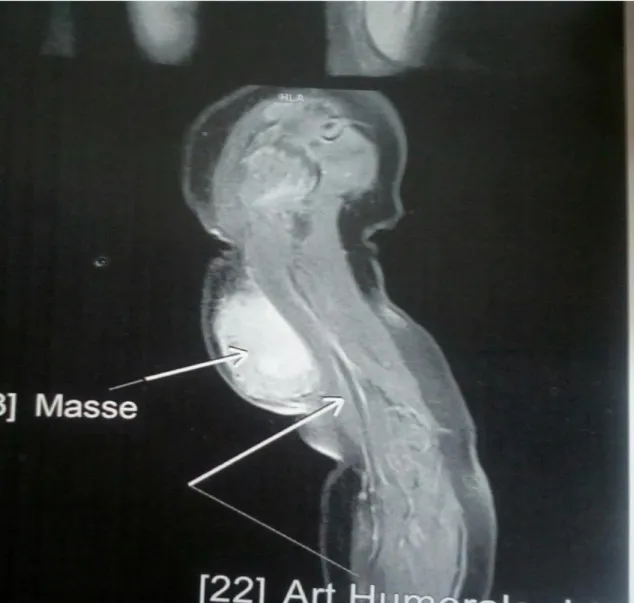 Figure 3 : IRM coupe sagittale du bras droit montrant la distance   intime entre la masse sous cutanée et l'artère humérale