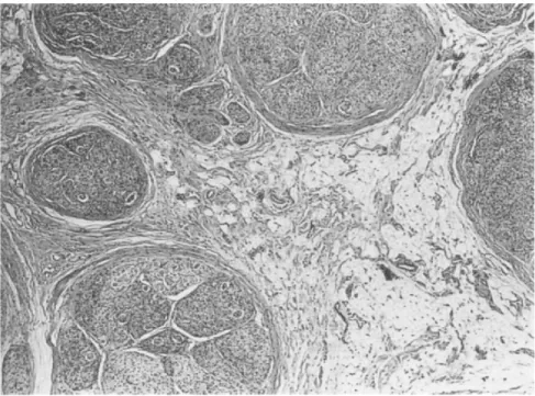 Figure 7 (22) faisceaux nerveux séparés par un tissu fibroadieux avec  une fibrose pér