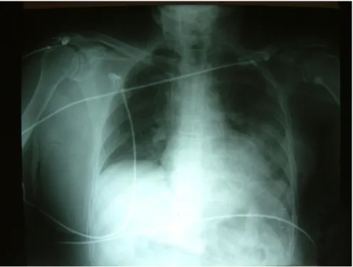 Figure 2 : Radio-pulmonaire post opératoire montrant une atélectasie du poumon  gauche, un drain thoracique, un cathéter veineux central dans la veine cave supérieure