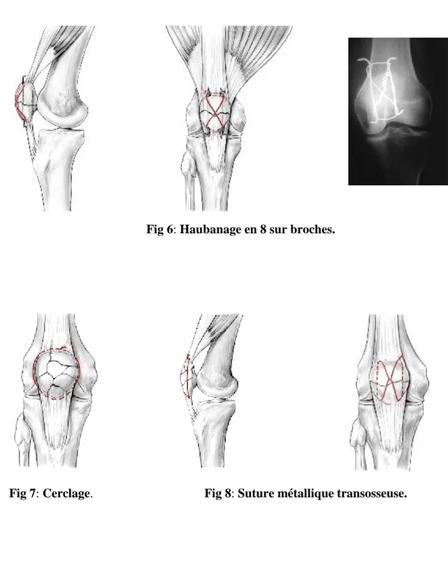 Fig 6: Haubanage en 8 sur broches. 