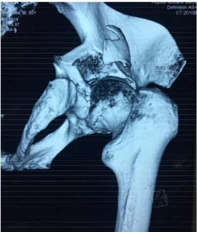 Figure 8: Examen TDM  de la hanche en reconstruction 3D montrant une fracture de la  paroi postérieure du cotyle associée à une luxation de la hanche