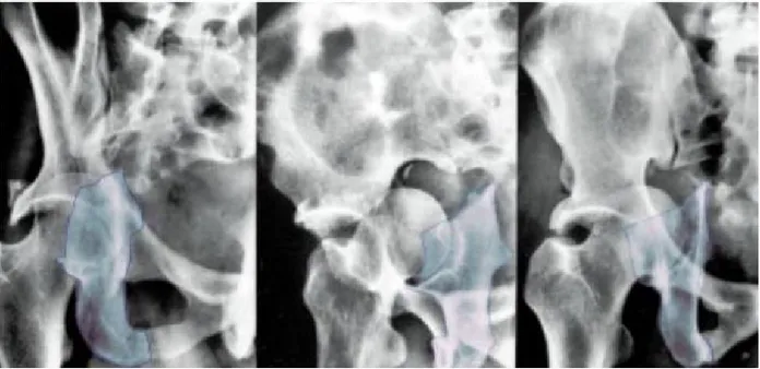 Figure 12: Fracture d’une colonne postérieure. Les traits de la colonne   postérieure sont surlignés