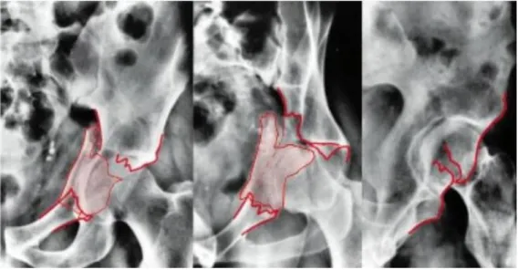 Figure 13: Fracture d’une paroi antérieure du cotyle. 