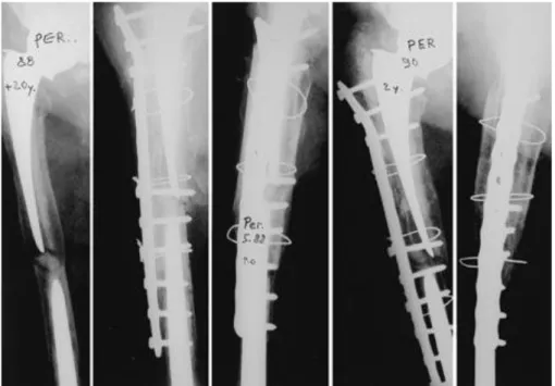 Figure 2. Chez un patient de 80 ans, ostéolyse entre une tige fémorale descellée mais peu  gênante et une tige de prothèse du genou