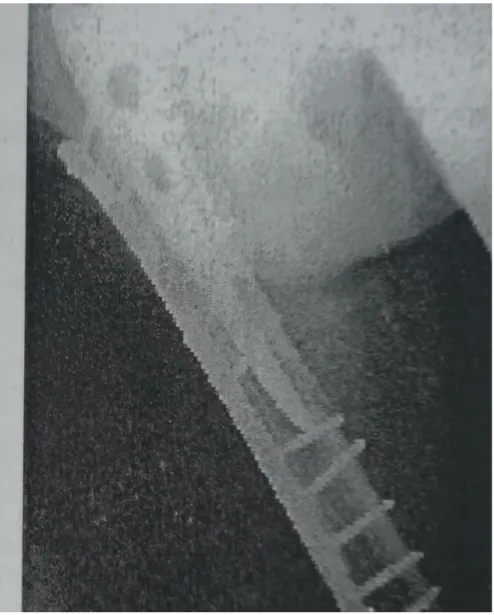 Figure 4-b : traitement par ostéosynthèse 