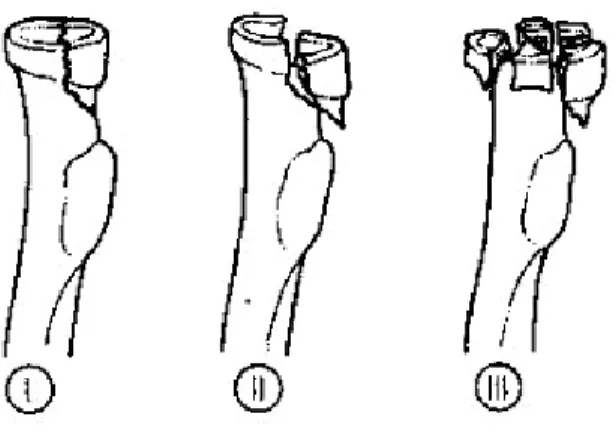 Figure  9 :  classification  de  Mason  des  fractures  de  la  tête  radiale  modifié  par  jonhston : [11]