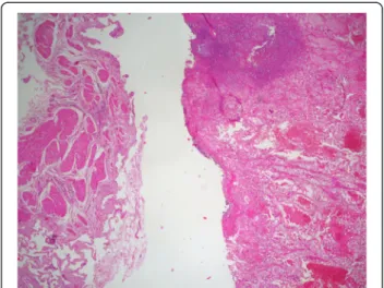 Figure 3 Representative micrograph shows that the polyp is composed of clear cell renal cell carcinoma in a background of normal gallbladder (Hematoxylin-eosin, original magnification x4).