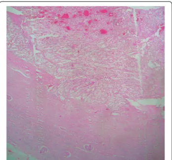 Figure 6 Immunohistochemical stain: The tumor cells are positive for vimentin.