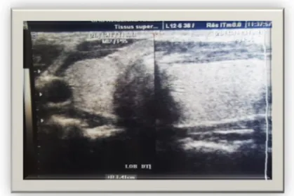 Figure 10 : Echographie cervicale montrant le lobe thyroïdien droit. 