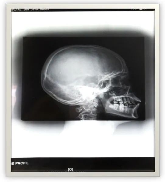 Figure 12 : Radiographie du crane en profil. 