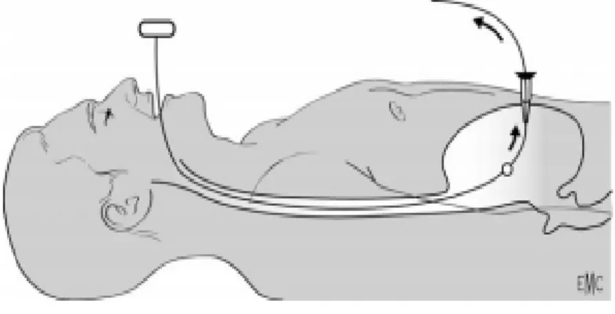 Figure 5 a: Traction de l’extrémité abdominale du fil guide   (photos du service de Gastro-entérologie II) 
